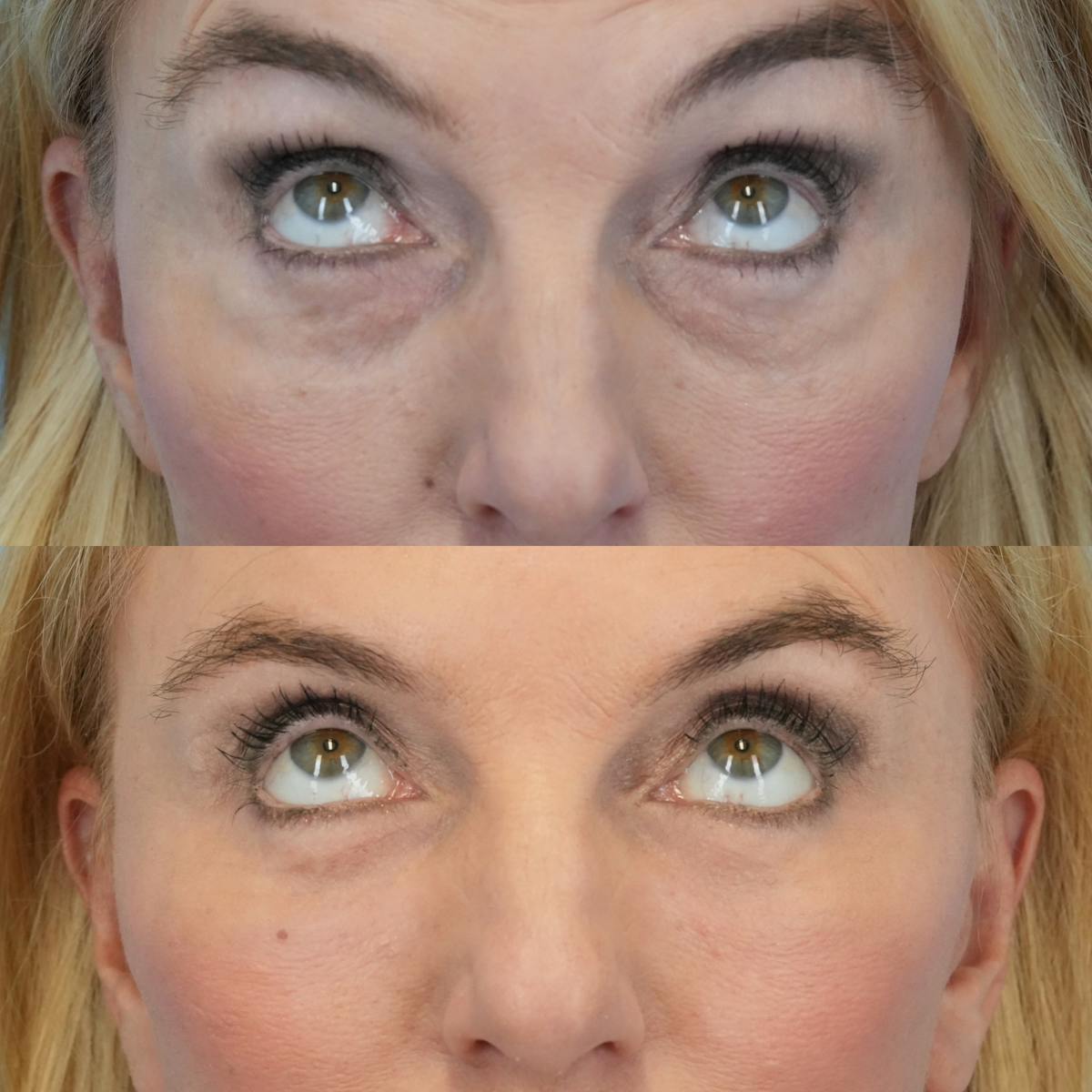 Blepharoplasty Before & After Gallery - Patient 616060 - Image 2