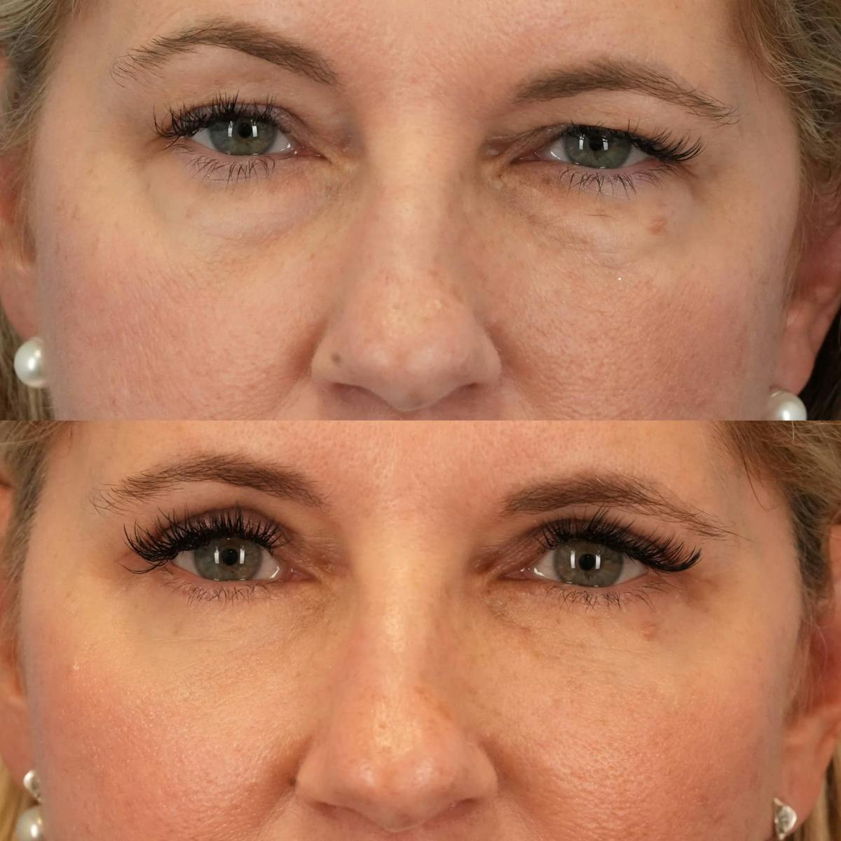 Blepharoplasty Before & After Gallery - Patient 180406 - Image 1