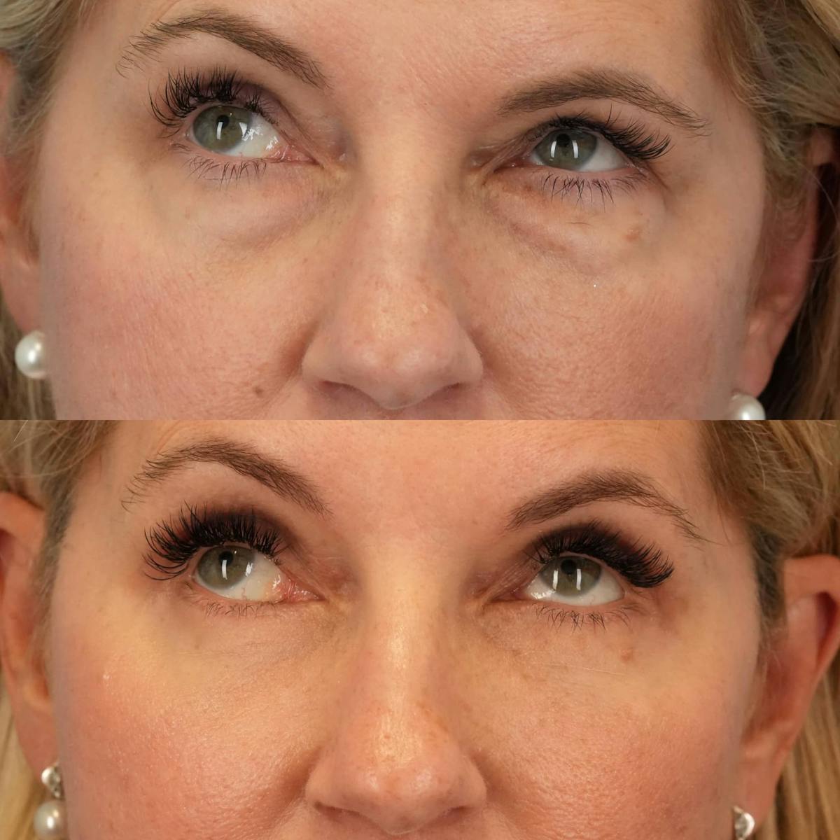 Blepharoplasty Before & After Gallery - Patient 180406 - Image 2