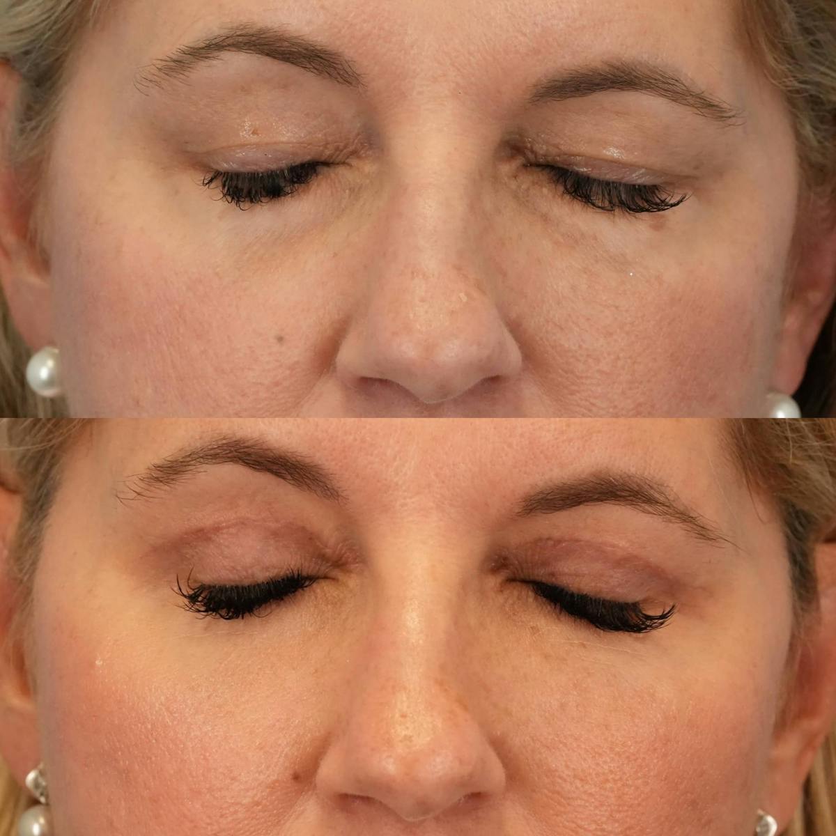 Blepharoplasty Before & After Gallery - Patient 180406 - Image 5