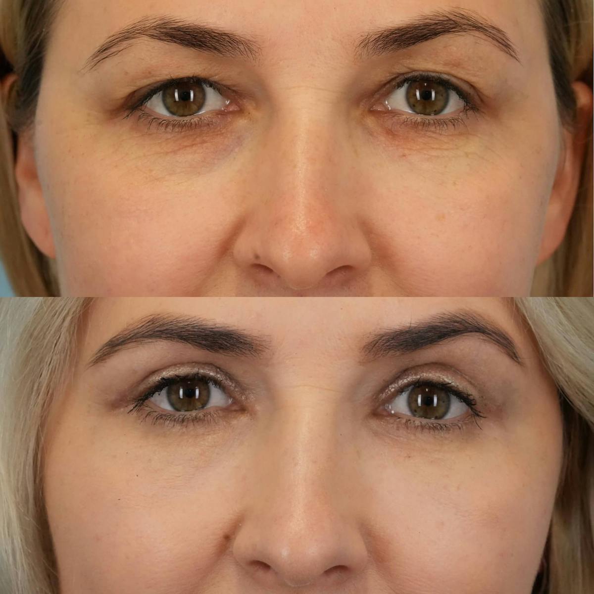 Blepharoplasty Before & After Gallery - Patient 173228 - Image 1