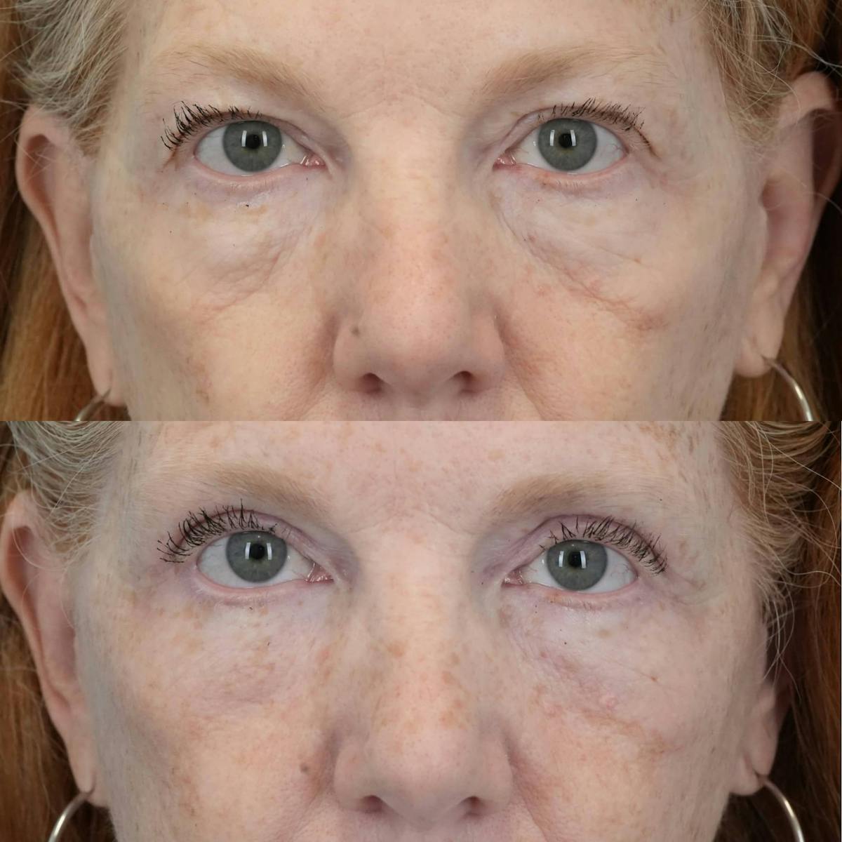 Blepharoplasty Before & After Gallery - Patient 414865 - Image 1