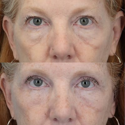 Blepharoplasty Before & After Gallery - Patient 414865 - Image 1