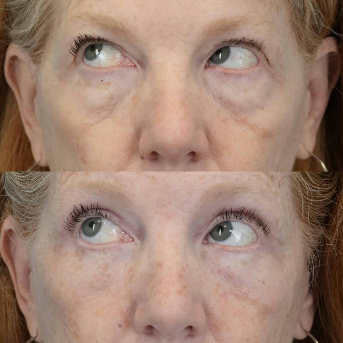 Blepharoplasty Before & After Gallery - Patient 414865 - Image 2