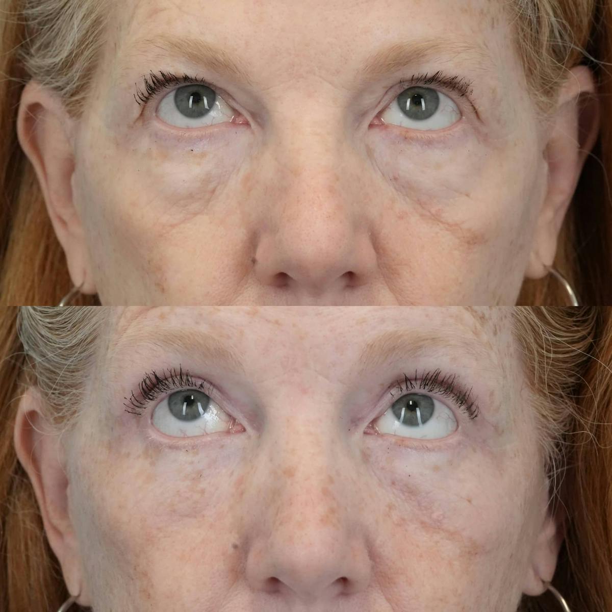 Blepharoplasty Before & After Gallery - Patient 414865 - Image 3