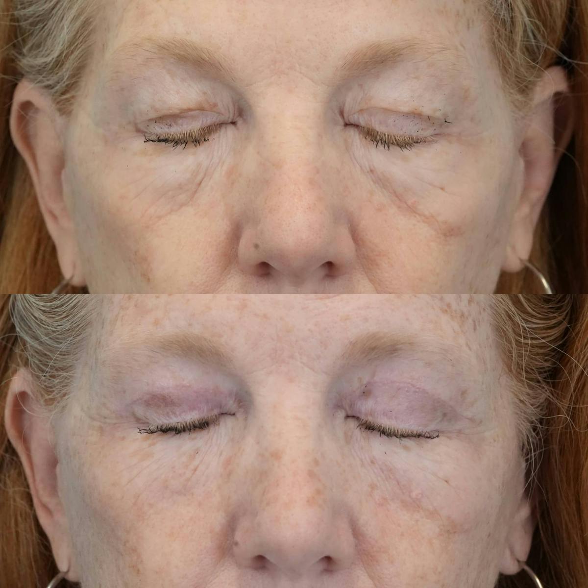 Blepharoplasty Before & After Gallery - Patient 414865 - Image 4