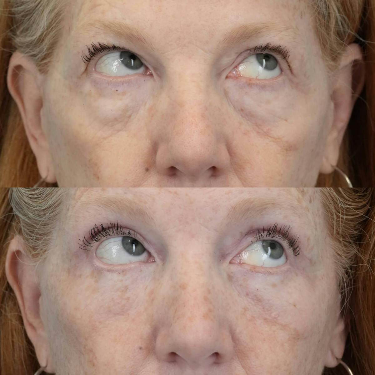 Blepharoplasty Before & After Gallery - Patient 414865 - Image 5