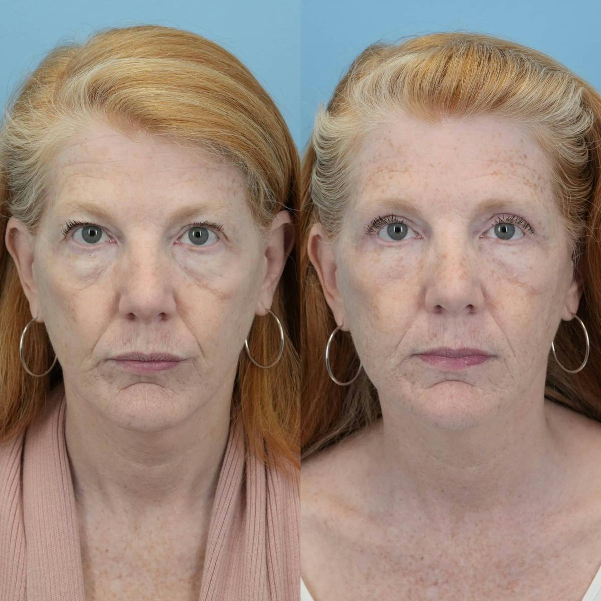 Blepharoplasty Before & After Gallery - Patient 414865 - Image 6