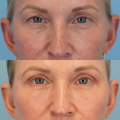Blepharoplasty Before & After Gallery - Patient 270678 - Image 1