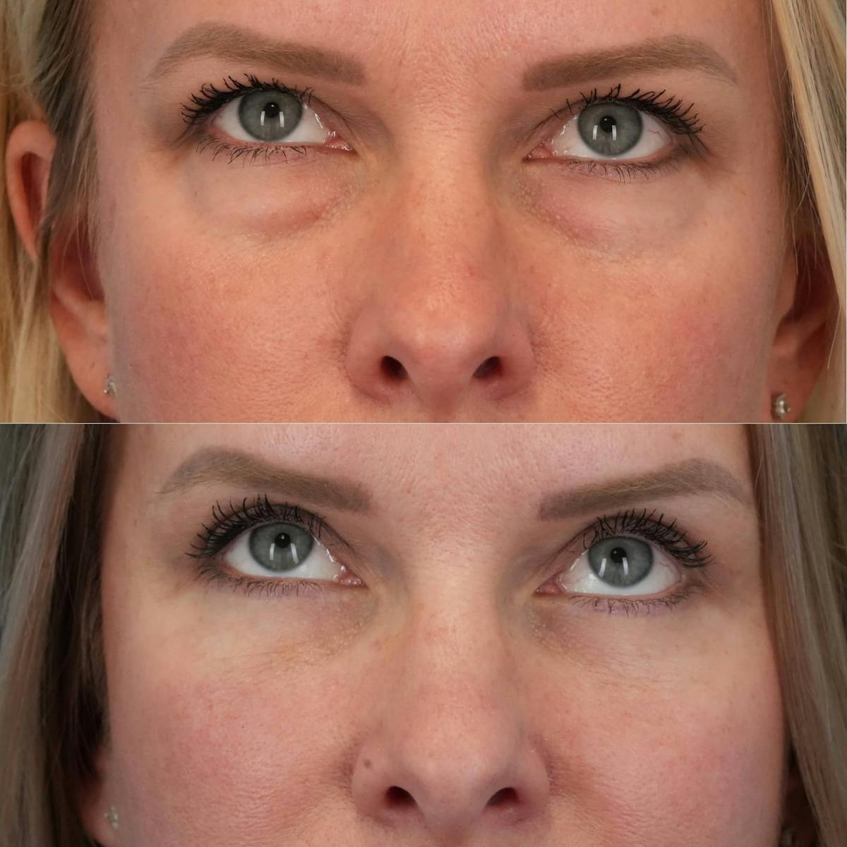 Blepharoplasty Before & After Gallery - Patient 341332 - Image 1