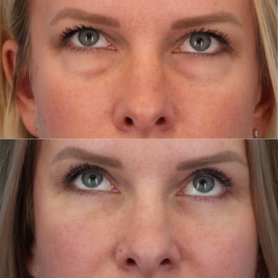 Blepharoplasty Before & After Gallery - Patient 341332 - Image 1