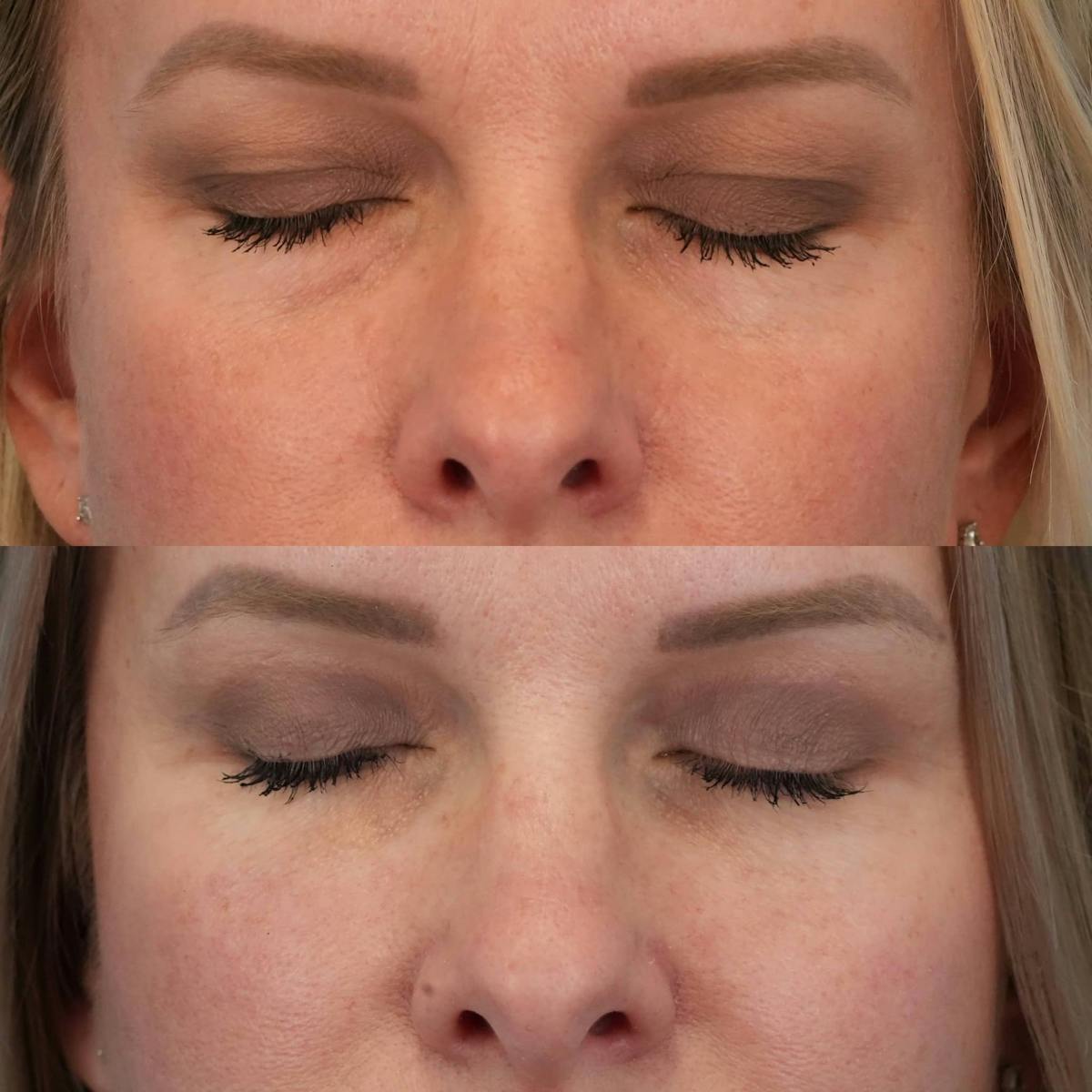 Blepharoplasty Before & After Gallery - Patient 341332 - Image 2