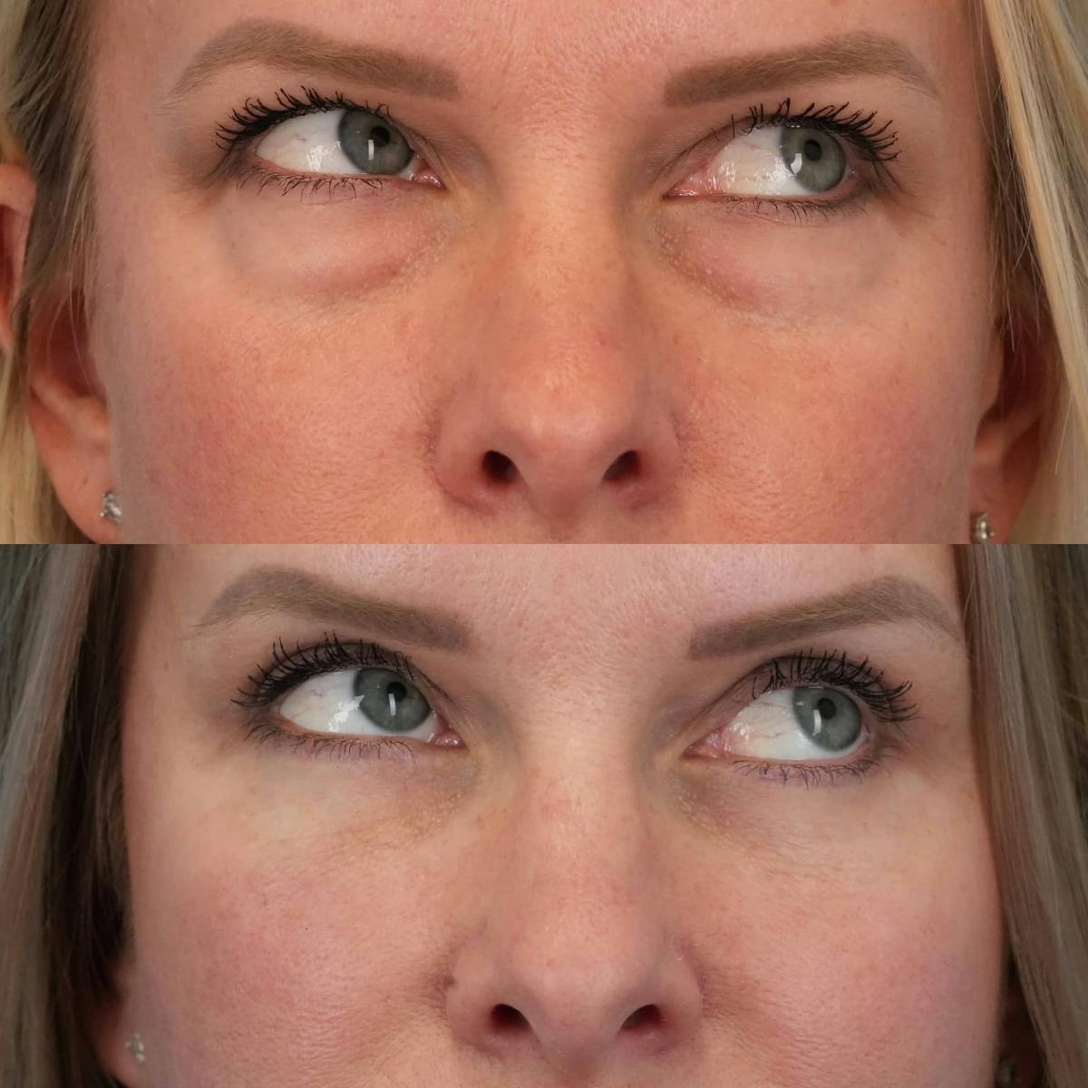 Blepharoplasty Before & After Gallery - Patient 341332 - Image 3