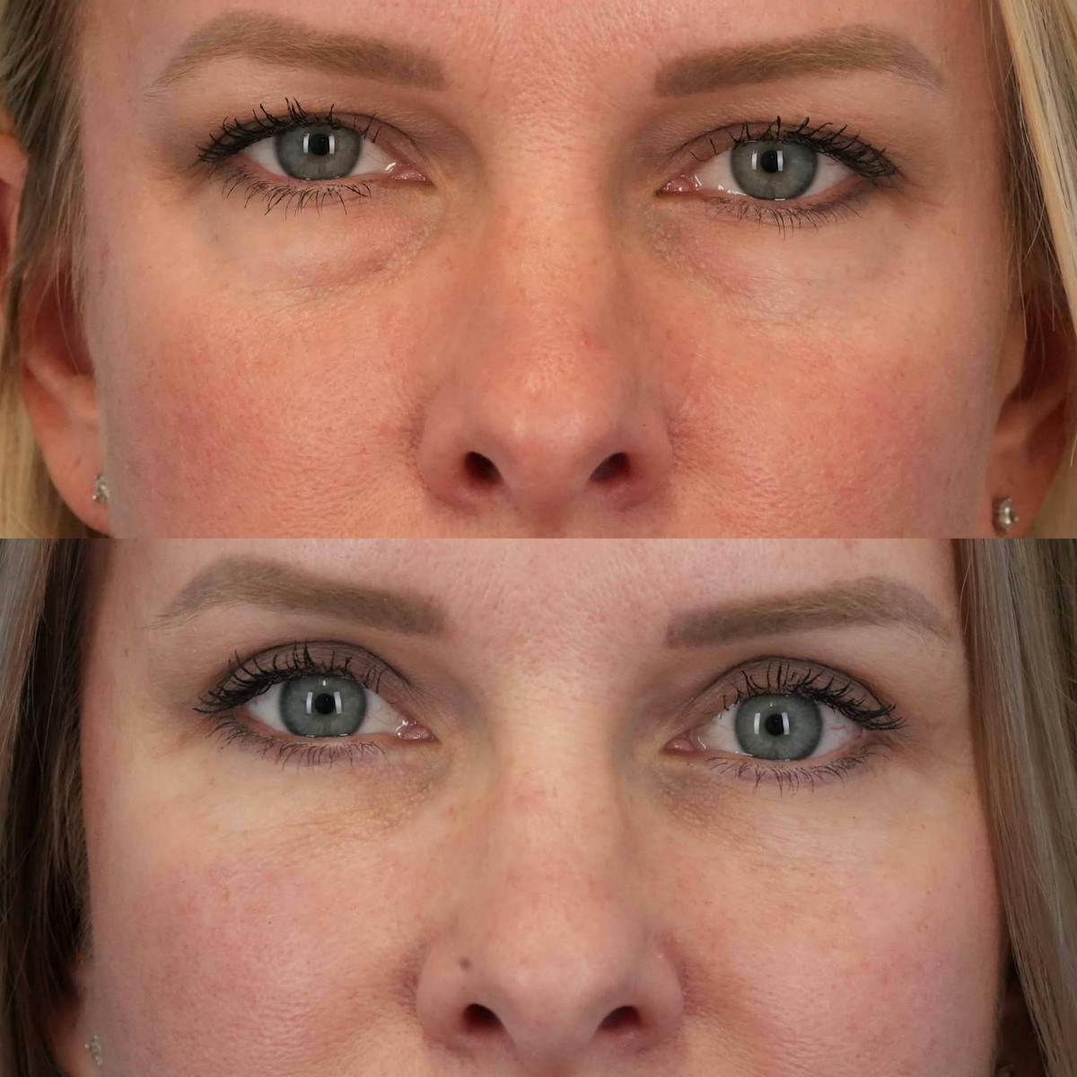 Blepharoplasty Before & After Gallery - Patient 341332 - Image 4
