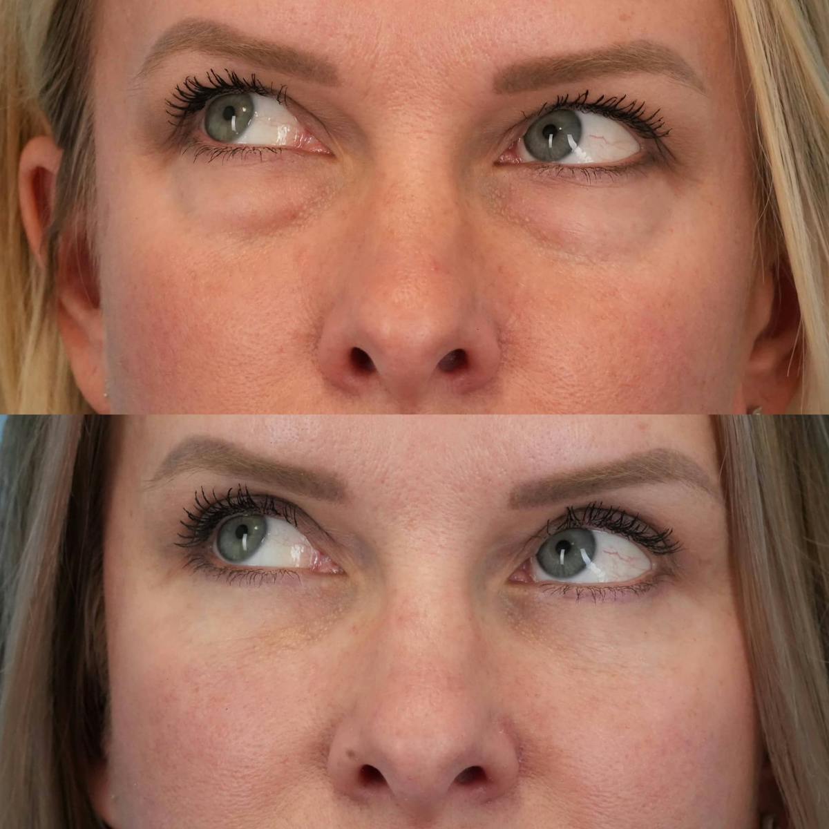 Blepharoplasty Before & After Gallery - Patient 341332 - Image 5