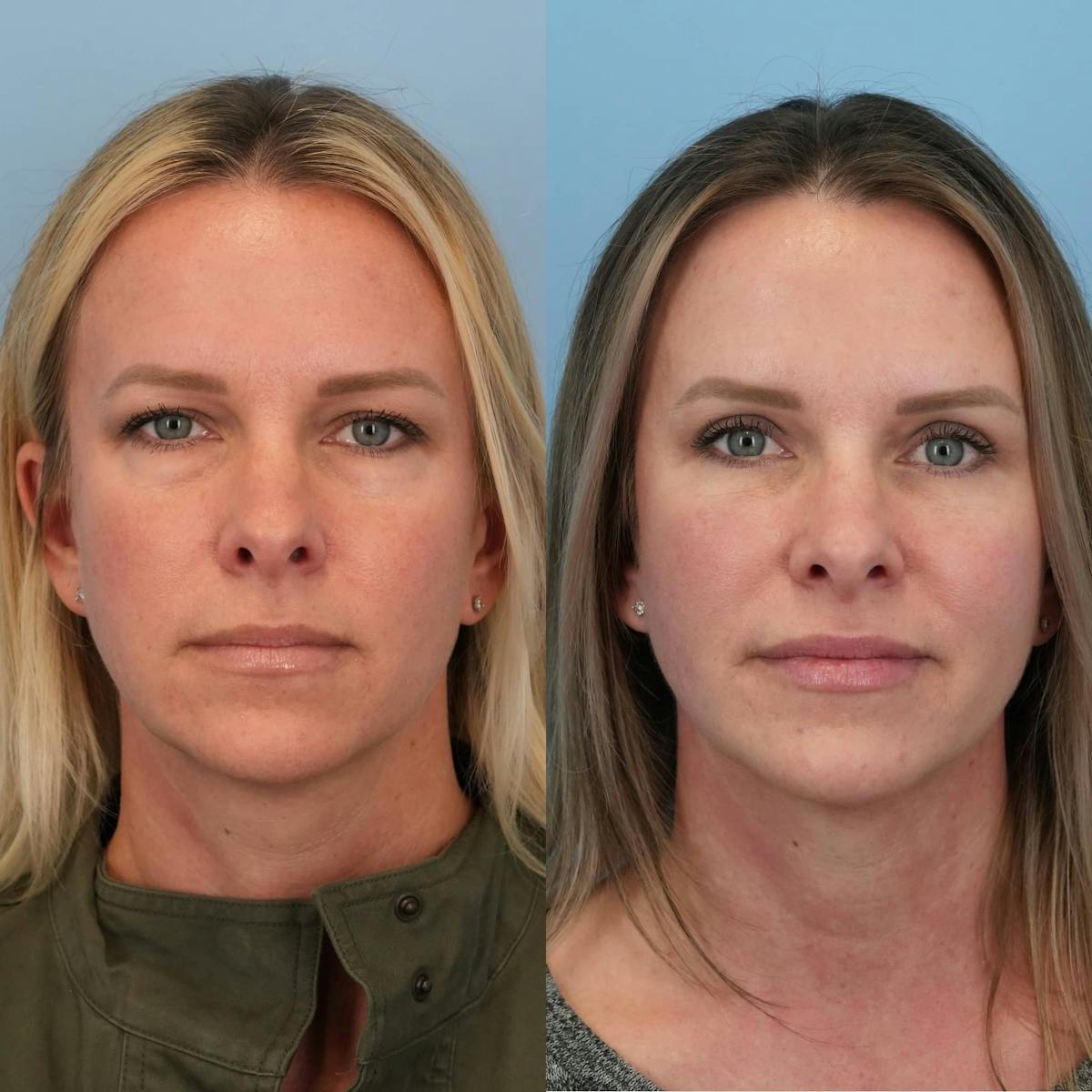Blepharoplasty Before & After Gallery - Patient 341332 - Image 6