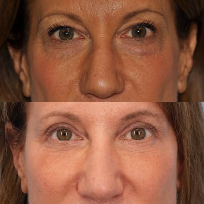 Blepharoplasty Before & After Gallery - Patient 336486 - Image 1