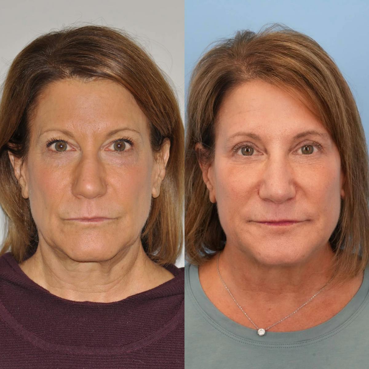 Blepharoplasty Before & After Gallery - Patient 336486 - Image 6