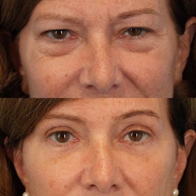 Blepharoplasty Before & After Gallery - Patient 100733 - Image 1