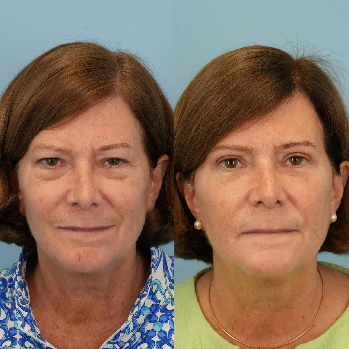 Blepharoplasty Before & After Gallery - Patient 100733 - Image 5
