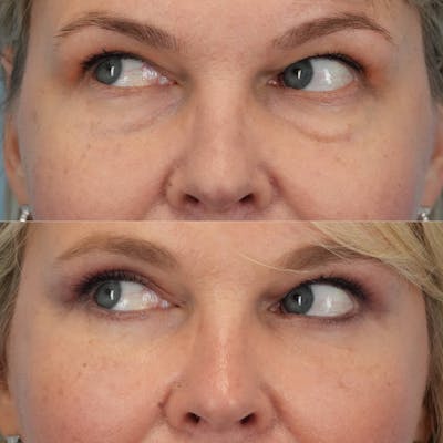 Blepharoplasty Before & After Gallery - Patient 126874 - Image 1