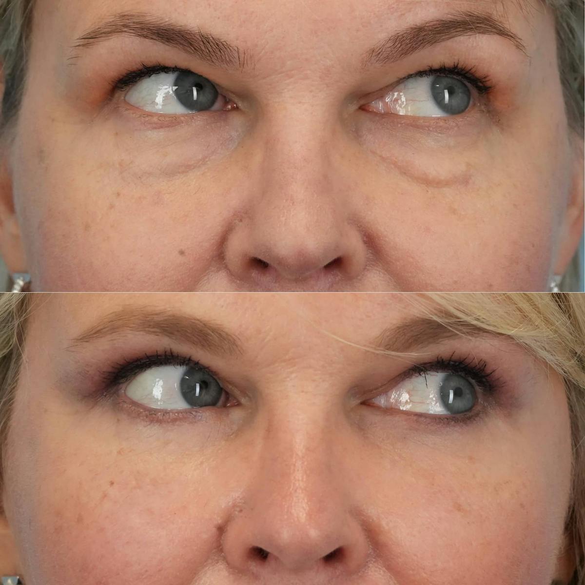 Blepharoplasty Before & After Gallery - Patient 126874 - Image 2