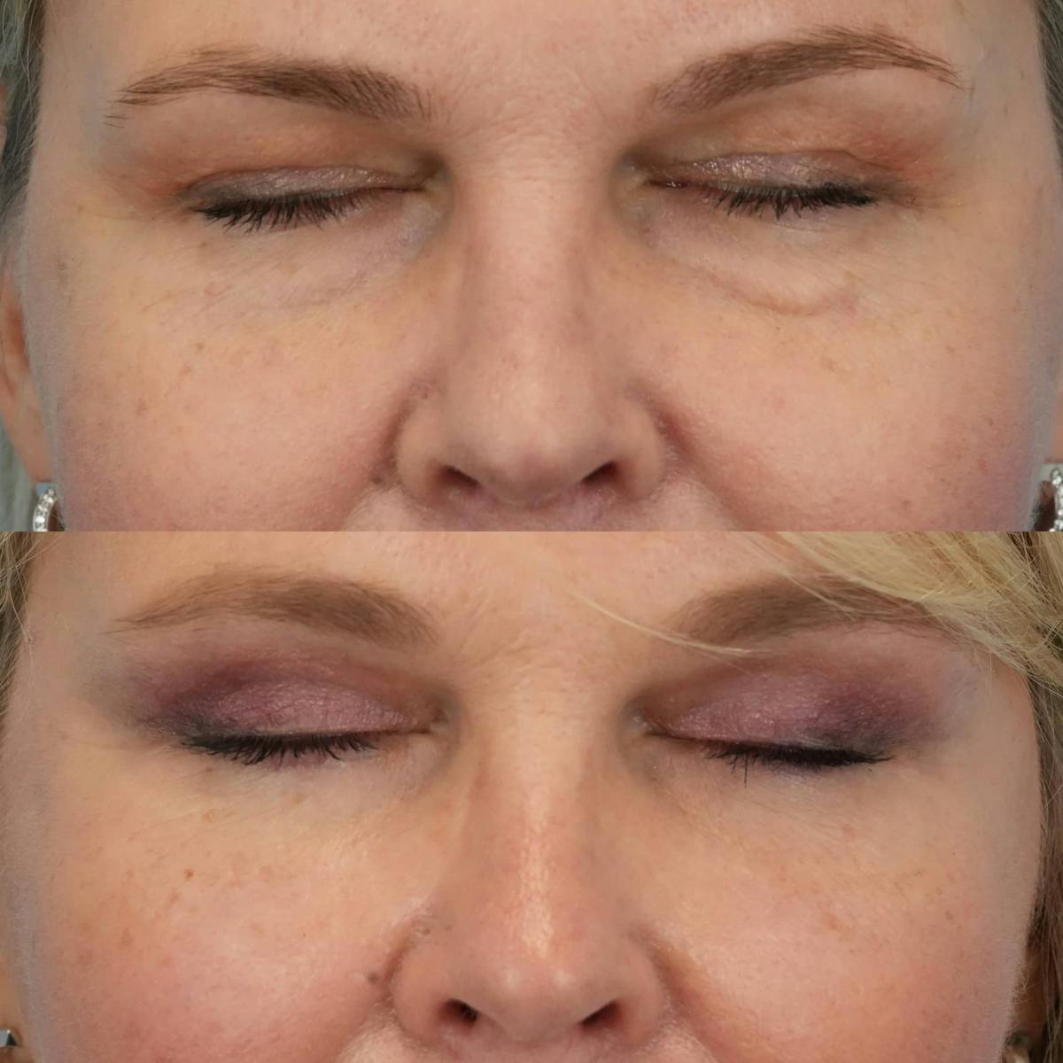 Blepharoplasty Before & After Gallery - Patient 126874 - Image 4