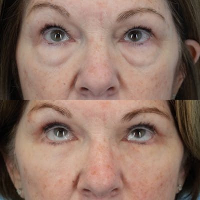 Blepharoplasty Before & After Gallery - Patient 405128 - Image 1