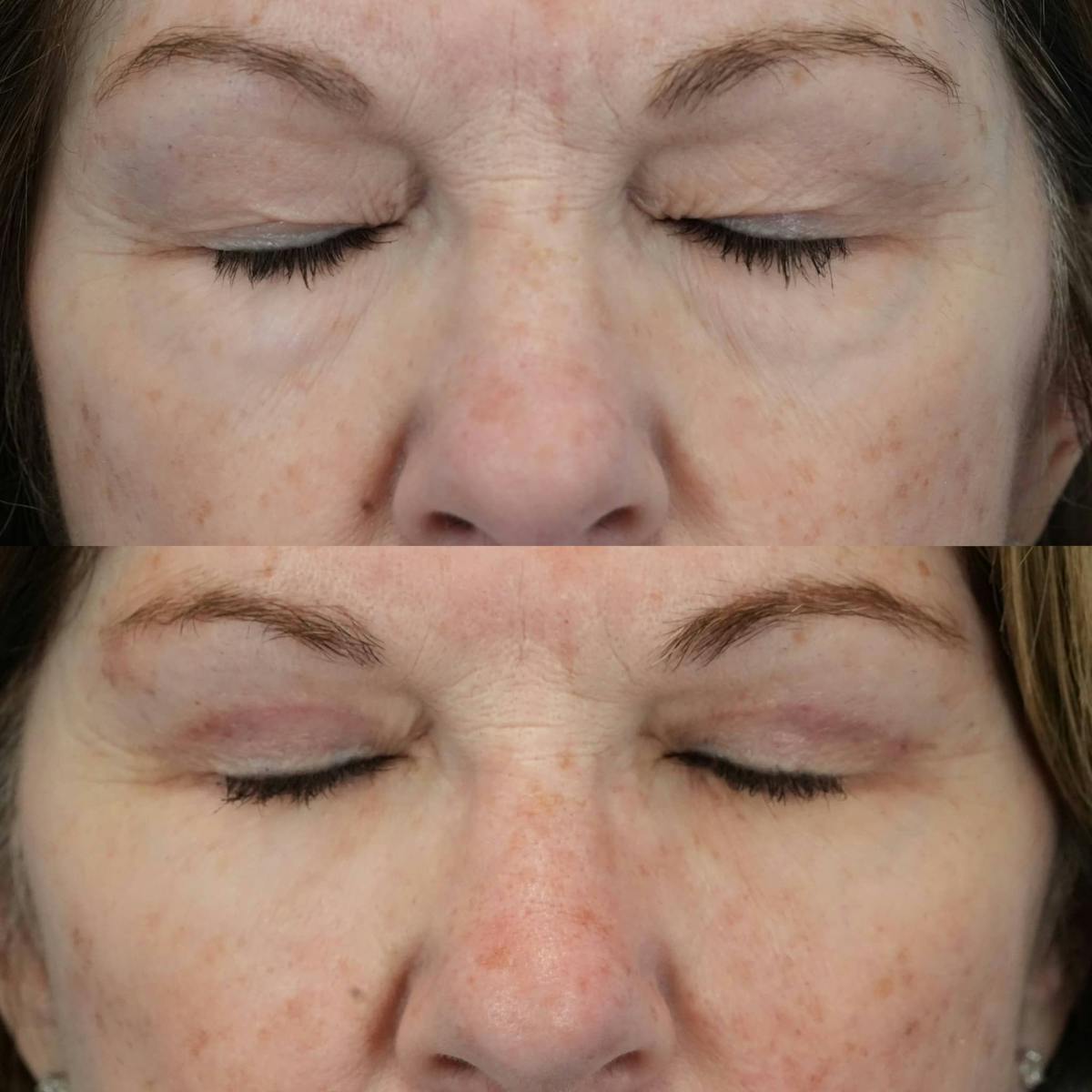 Blepharoplasty Before & After Gallery - Patient 405128 - Image 3