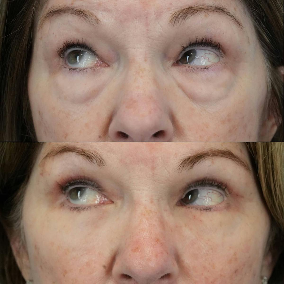 Blepharoplasty Before & After Gallery - Patient 405128 - Image 4