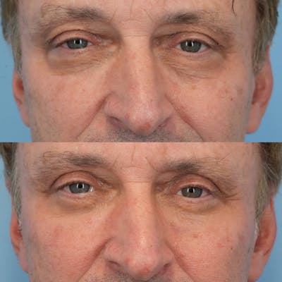 Blepharoplasty Before & After Gallery - Patient 957165 - Image 1