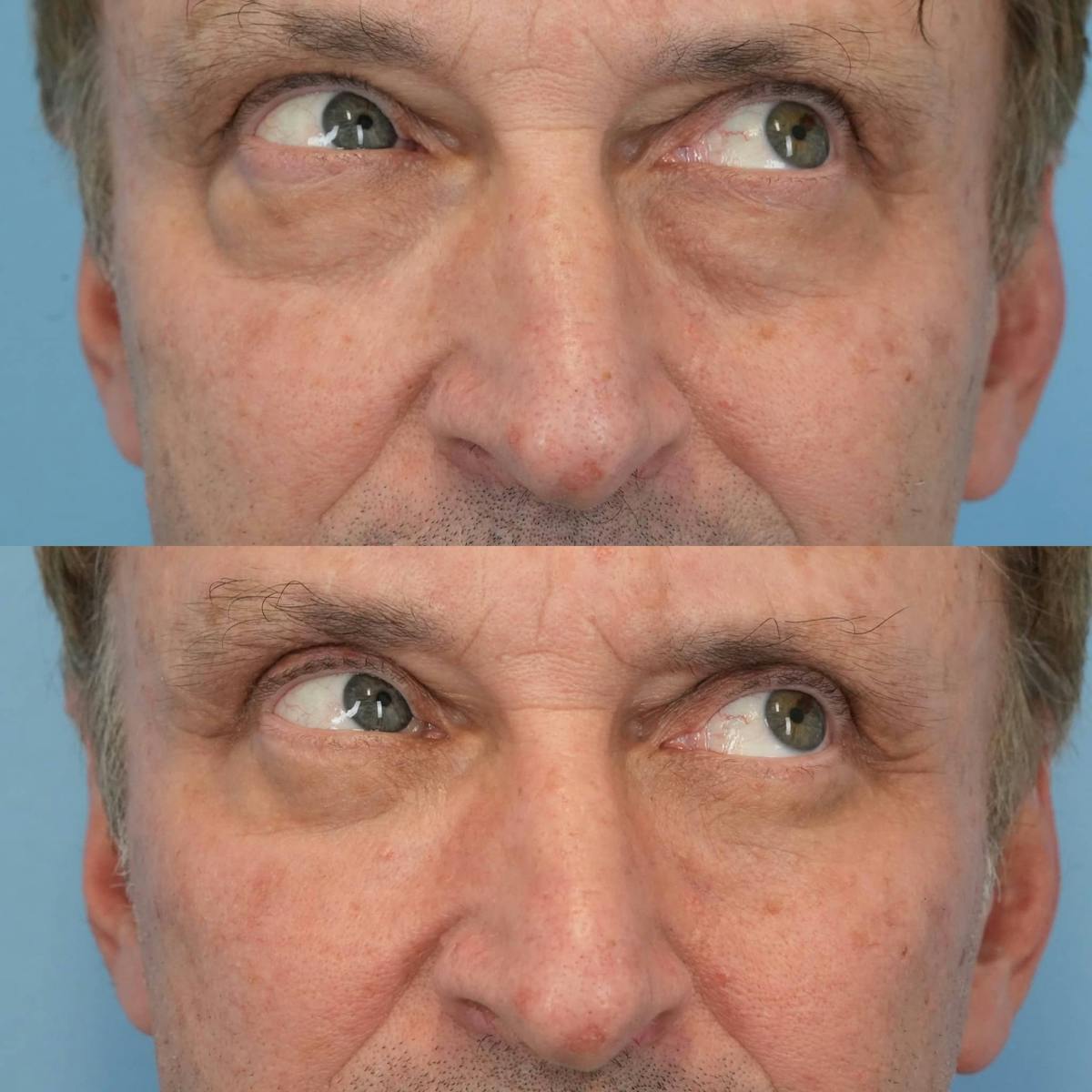 Blepharoplasty Before & After Gallery - Patient 957165 - Image 4