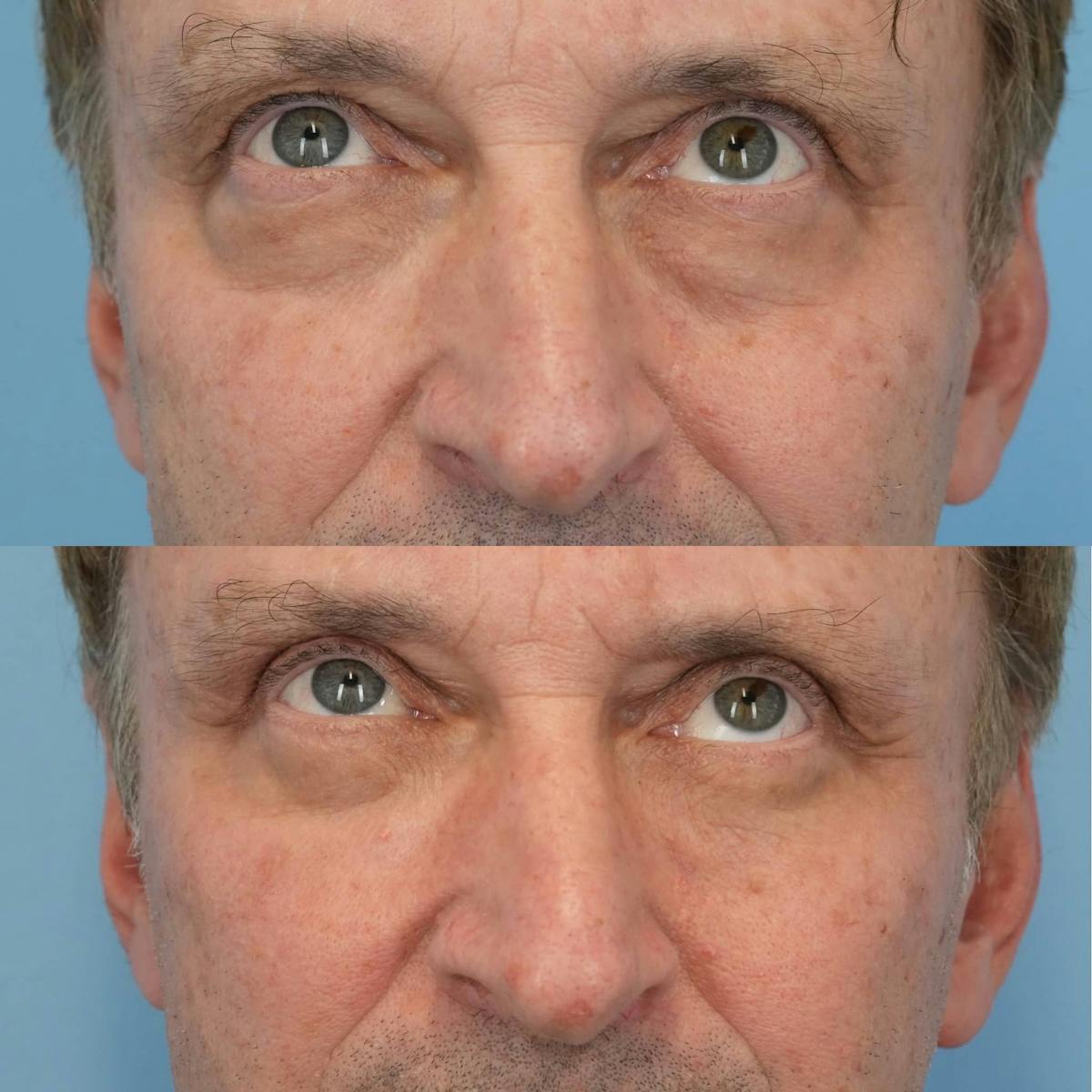 Blepharoplasty Before & After Gallery - Patient 957165 - Image 5