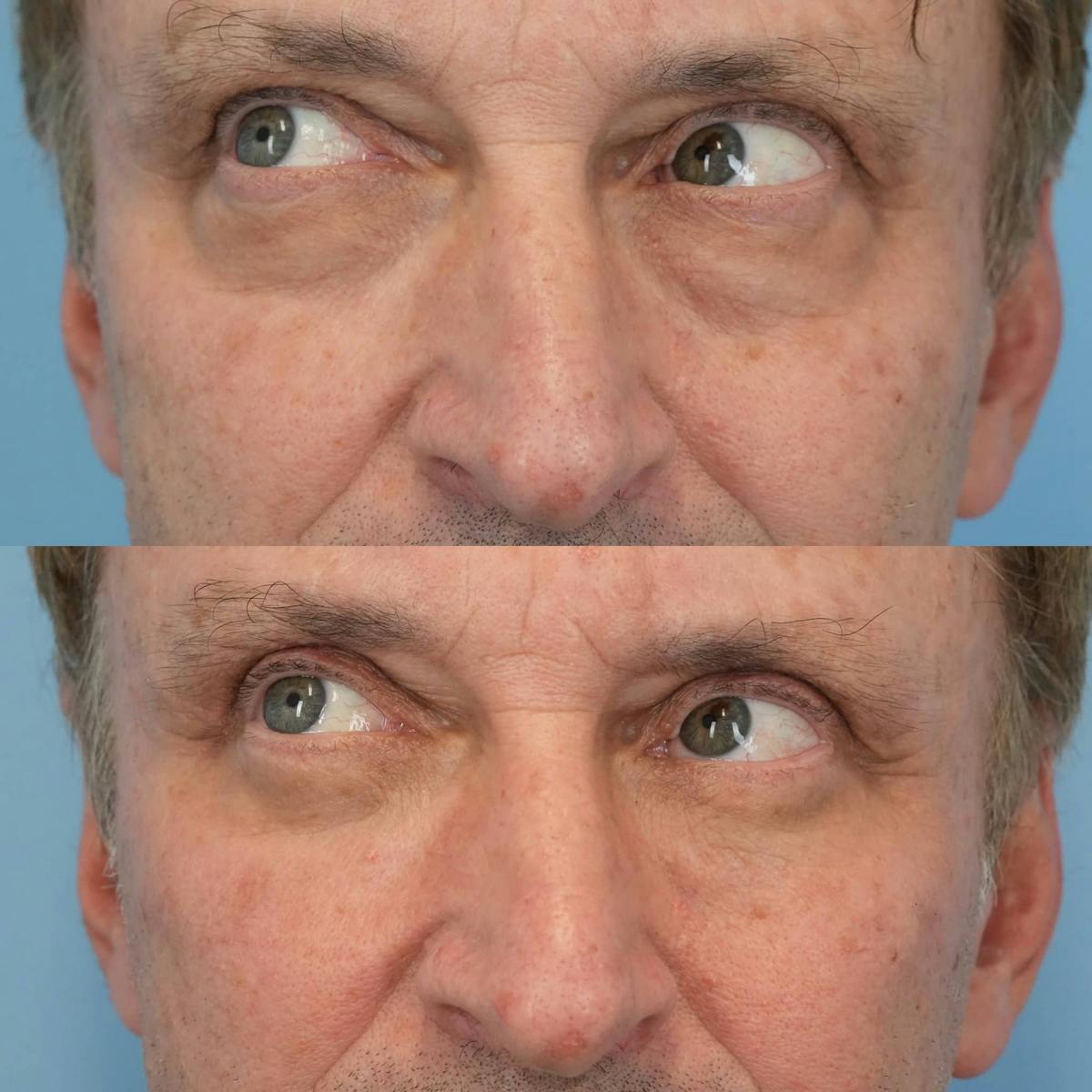 Blepharoplasty Before & After Gallery - Patient 957165 - Image 6