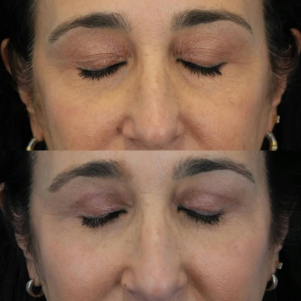 Blepharoplasty Before & After Gallery - Patient 267257 - Image 4