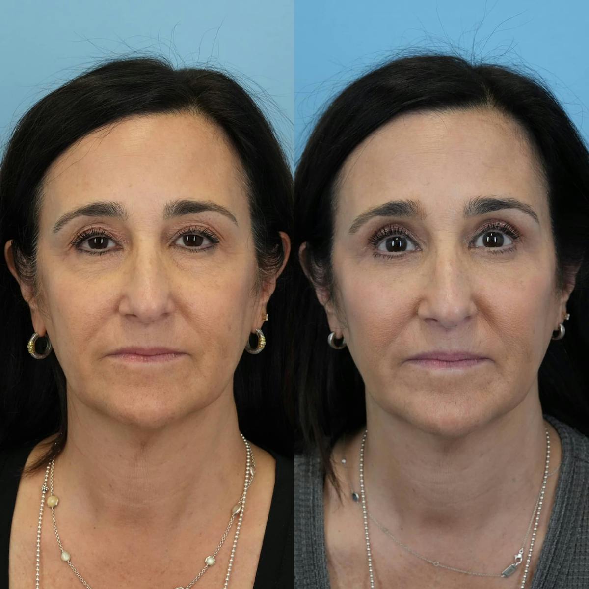 Blepharoplasty Before & After Gallery - Patient 267257 - Image 6