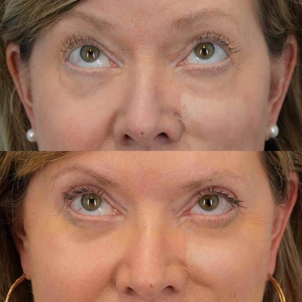 Blepharoplasty Before & After Gallery - Patient 165795 - Image 1