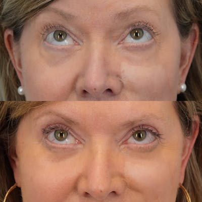 Blepharoplasty Before & After Gallery - Patient 165795 - Image 1