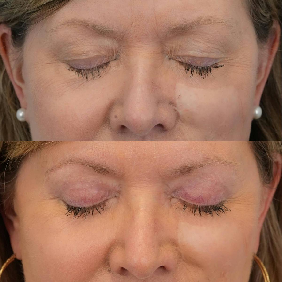 Blepharoplasty Before & After Gallery - Patient 165795 - Image 2