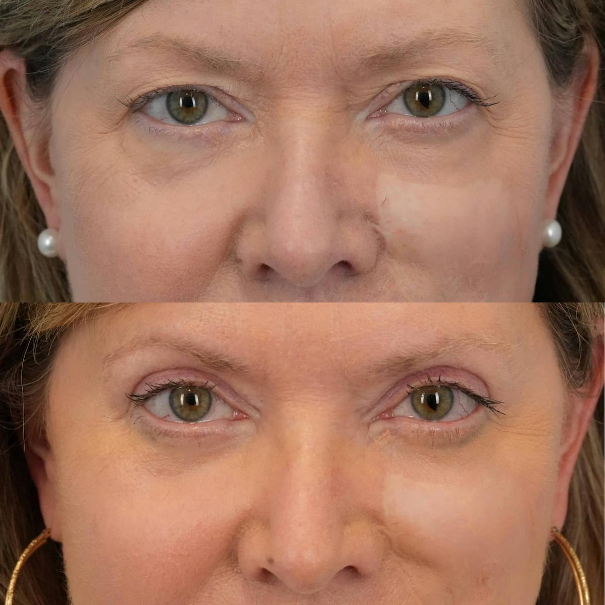 Blepharoplasty Before & After Gallery - Patient 165795 - Image 5