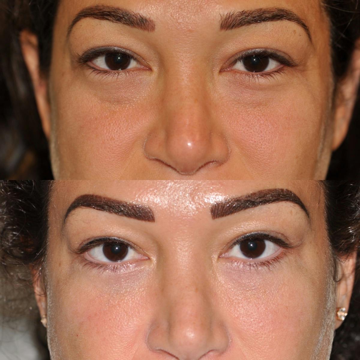 Blepharoplasty Before & After Gallery - Patient 310368 - Image 2