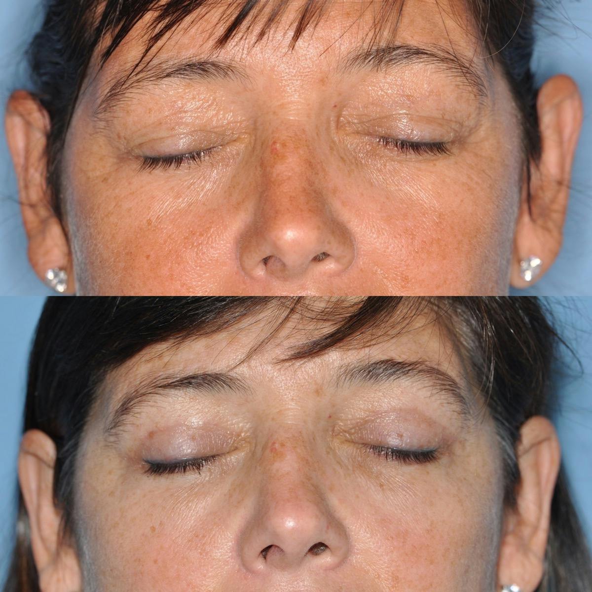 Blepharoplasty Before & After Gallery - Patient 173632 - Image 3