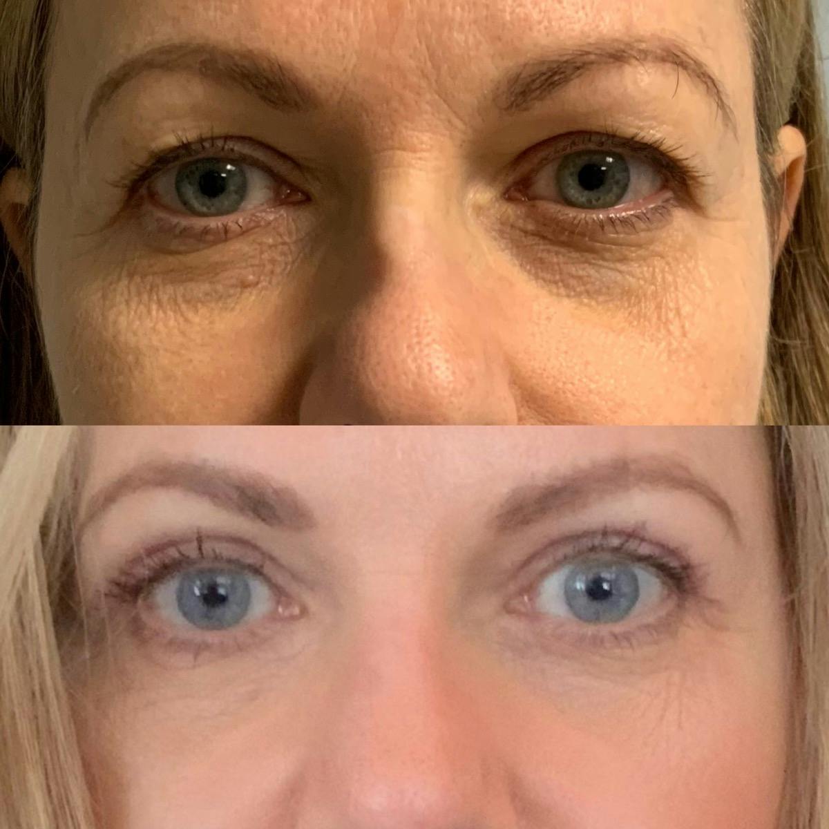 Blepharoplasty Before & After Gallery - Patient 978396 - Image 1