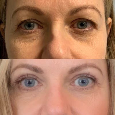 Blepharoplasty Before & After Gallery - Patient 978396 - Image 1