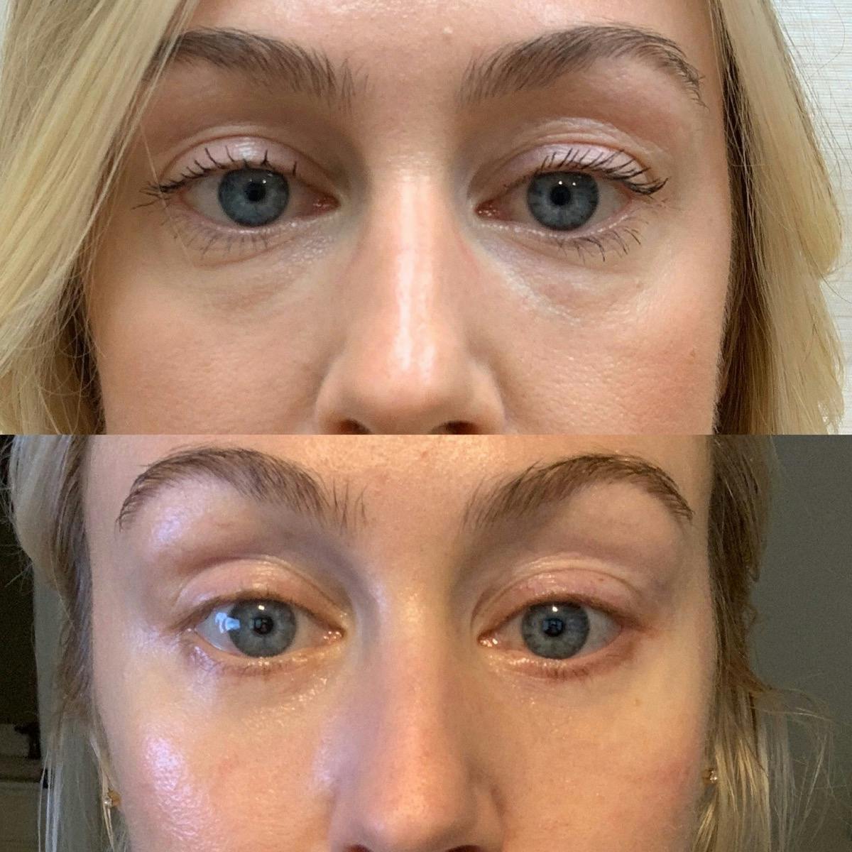 Blepharoplasty Before & After Gallery - Patient 239835 - Image 1