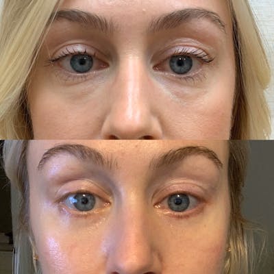 Blepharoplasty Before & After Gallery - Patient 239835 - Image 1