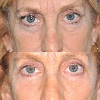 Blepharoplasty Before & After Gallery - Patient 416826 - Image 1