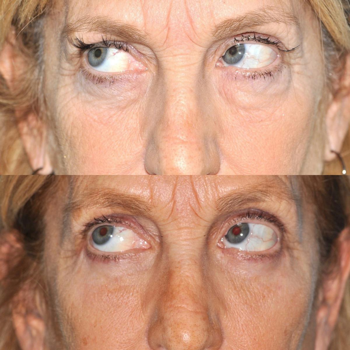 Blepharoplasty Before & After Gallery - Patient 416826 - Image 2