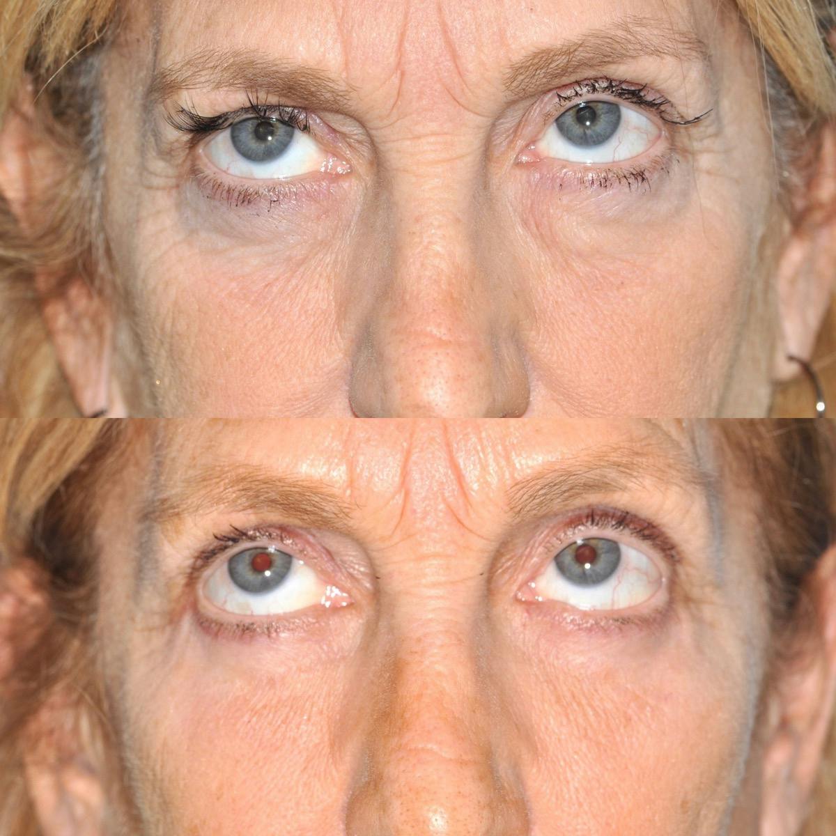 Blepharoplasty Before & After Gallery - Patient 416826 - Image 3