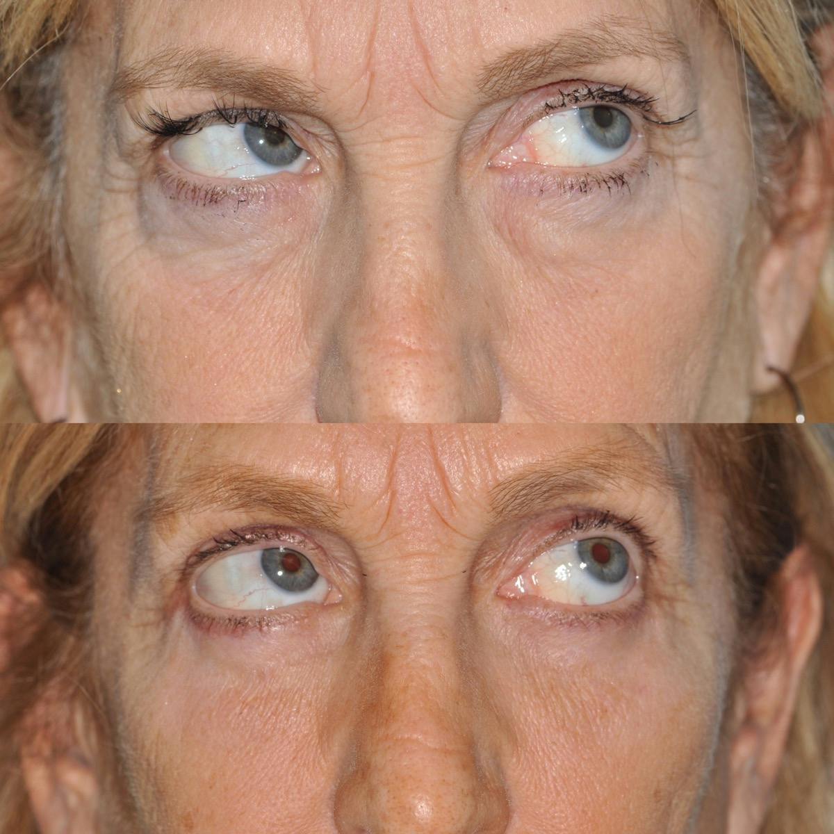 Blepharoplasty Before & After Gallery - Patient 416826 - Image 4